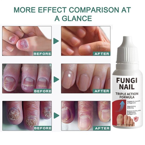 Fungi nail anti fungal liquid - nail,