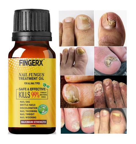 Best fungal nail treatment - treatment,