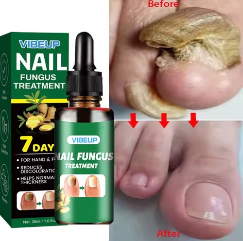 Nail fungus treatment - nail,