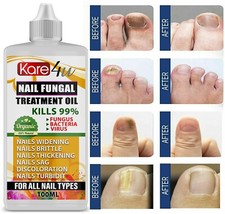 BEST Fungal Nail Treatment -