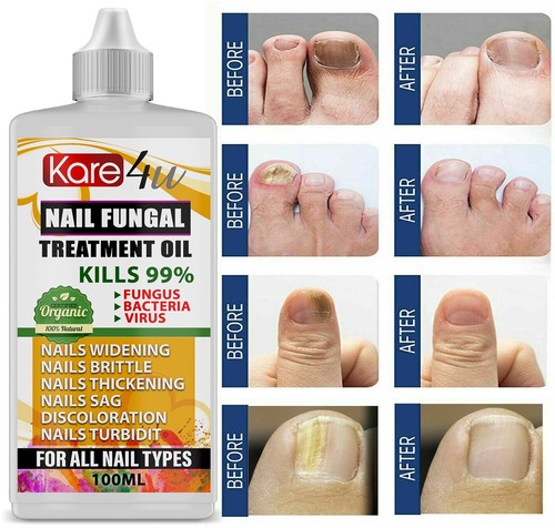Best fungal nail treatment - nail,