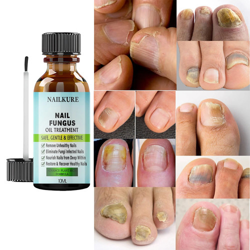 Nail fungal treatment anti - nail,