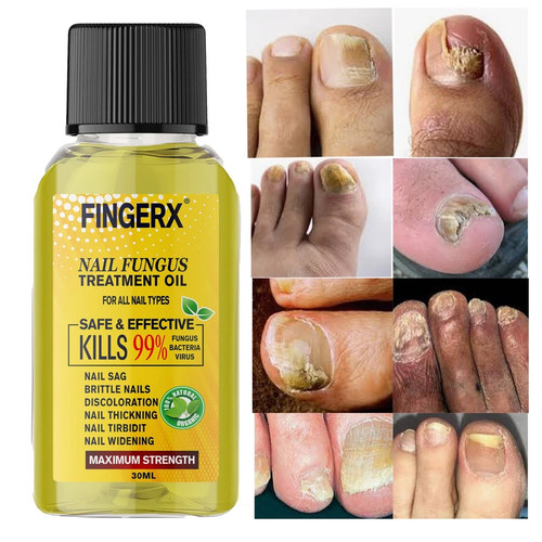 30ml fungal nail - fungal,