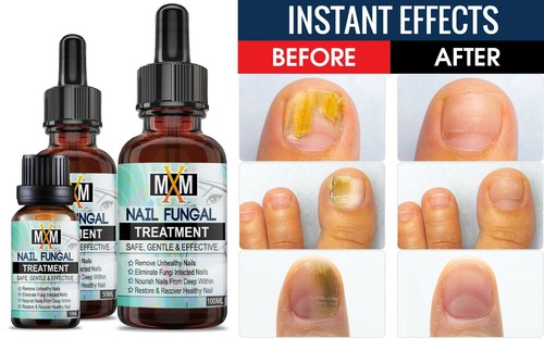 2021 fungal nail treatment - 2021,