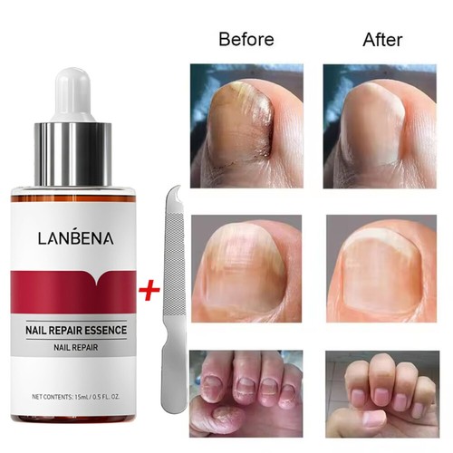 Anti fungal nail treatment - fungal,