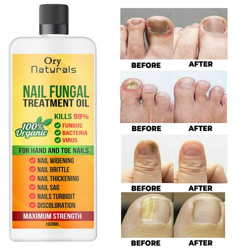 Nail fungal treatment fungus - nail,