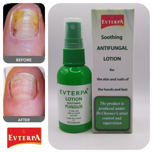 Fungal nail treatment anti - nail,
