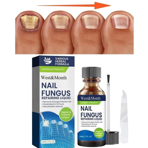 Fungal nail treatment - nail,