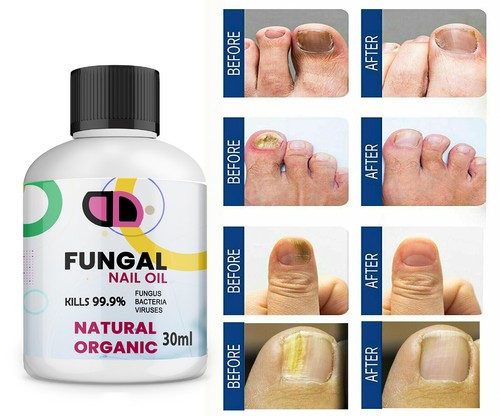 30ml fungal nail treatment - fungal,