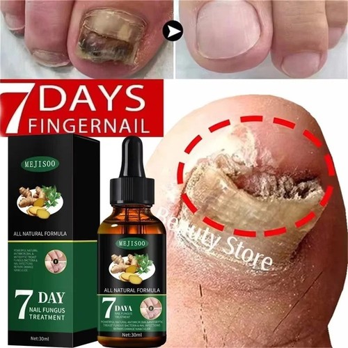 Fungal nail treatment - fungal,