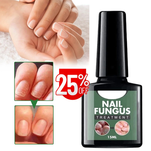 Fungal nail treatment - treatment, liquid