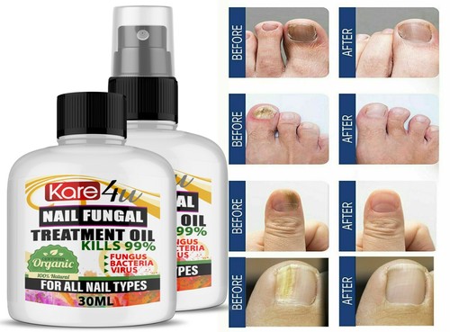 30ml fungal nail - 30ml,