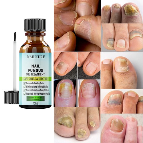 Nail fungal treatment - fungal, anti