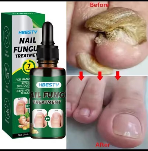 Fungus days nail - 7,